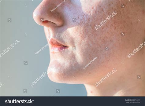 Acne Scars On Woman Face Closeup Stock Photo 2022718697 | Shutterstock