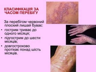 Червоний плескатий лишай лекція дерматологія | PPT