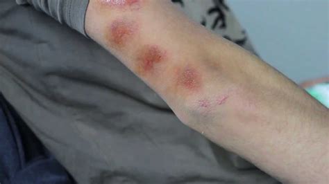 How to Create Bruises with Skin Illustrator - YouTube