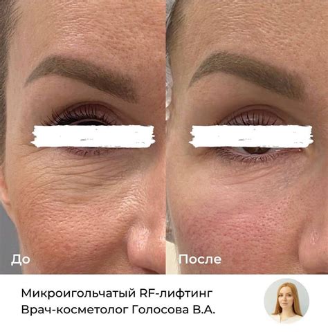 Игольчатый РФ-лифтинг лица и тела: цена, фото до и после