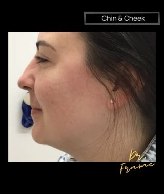 FDA-Approved Under Chin Fat Removal: Destroy Fat Cells Under the Chin