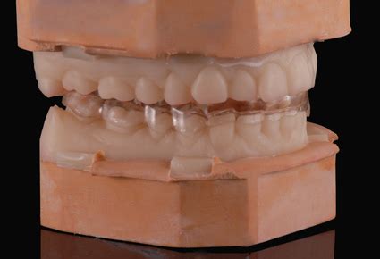 Каппы, шины, сплинты | зуботехническая лаборатория Dentservice