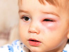 Conjunctivitis in children :: Frimley HealthierTogether