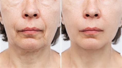 treatments   sagging face