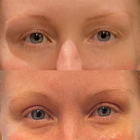 Eyelid Lift Archives - Adam Bryce Weinfeld, MD, Board-Certified Plastic ...