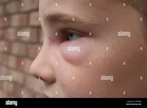 Profile picture of a young boy with swelling of face due to hornet ...