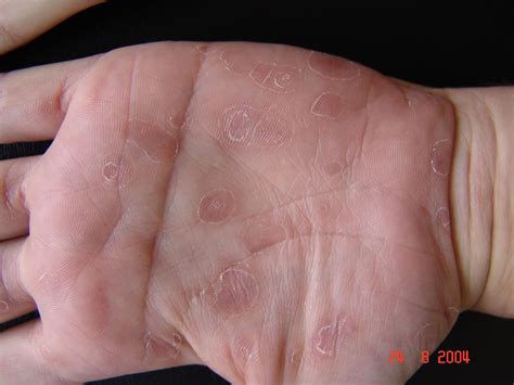Syphilis stages, signs, symptoms, diagnosis, treatment and syphilis cure