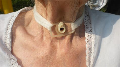 Tracheostomy care at home - Caring for tracheostomy - Aspire UK