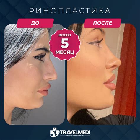 Ринопластика - TravelMEDI