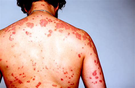 Maculopapular Rash Hiv