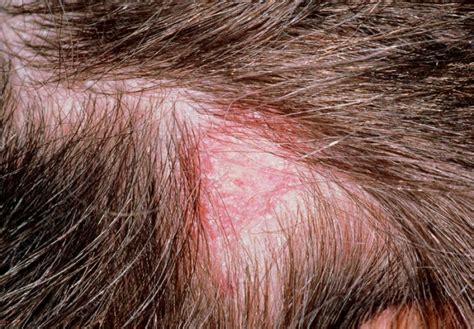 O Que É Dermatite No Couro Cabeludo - Dermatite Seborreica no Couro Cabeludo: O Que É e Como Tratar - Grandha ...