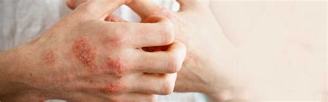 eczema dermatologist