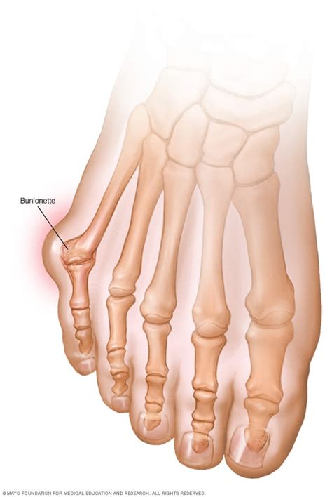 Bunion - Mayo Clinic