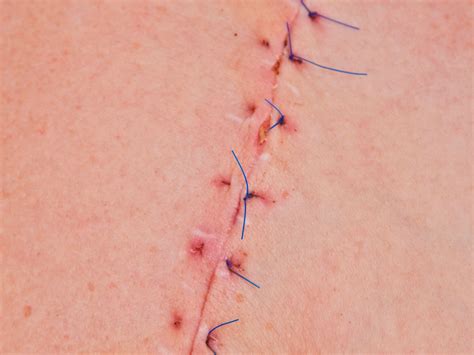 Scar Tissue Removal