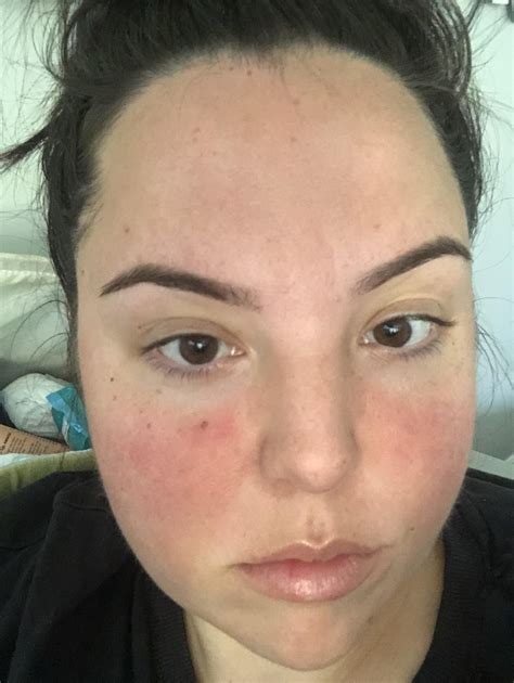 moles on face meaning 2