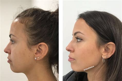 Botox for Jowls: Non Surgical Jowl Lift - Dr Aesthetica in 2023 | Jowl ...