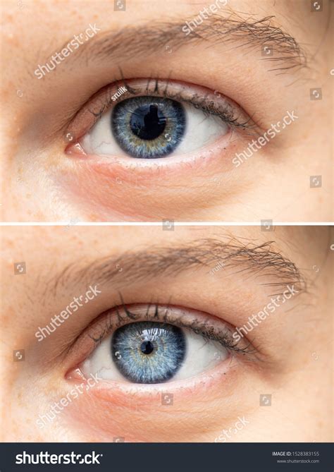93 Constricted pupil Images, Stock Photos & Vectors | Shutterstock
