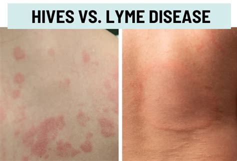 Hives (Urticaria) vs. Rash: Pictures and Differences