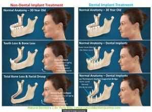 Dental Implant Dentist | Implant Surgery