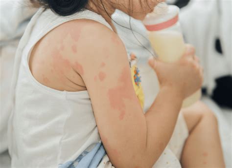 Dermatitis Caused By Textiles _ Contact Dermatitis In Clothing – WWFJOO