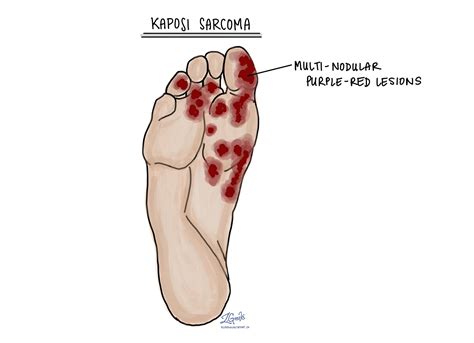 What Is Kaposi's Sarcoma at James Depew blog