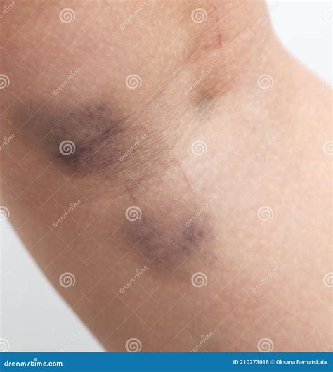 Large Bruise on the Skin on the Leg Stock Photo - Image of child, bump
