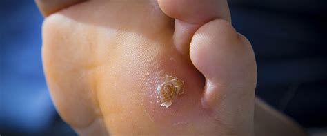 common foot problems    treat   experts perspective