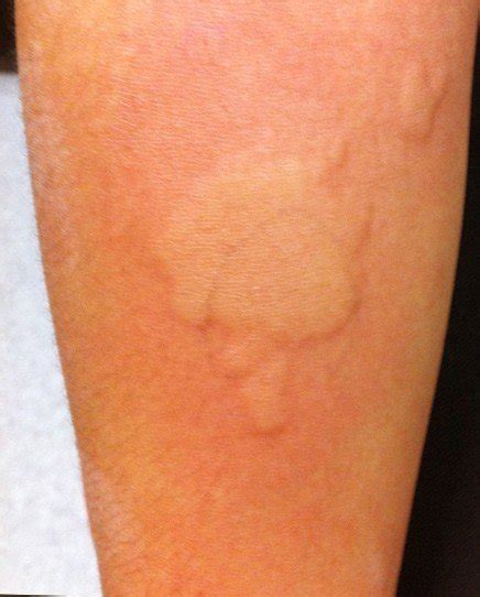 Allergic Reaction Skin Rash Treatment