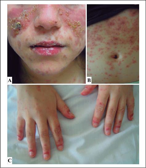 Eritema Multiforme Labios Menores Redalyc.Eritema Multiforme Asociado