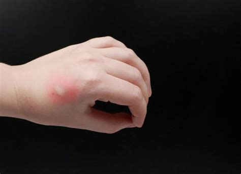 320+ Mosquito Bite Swelling Stock Photos, Pictures & Royalty-Free Images - iStock