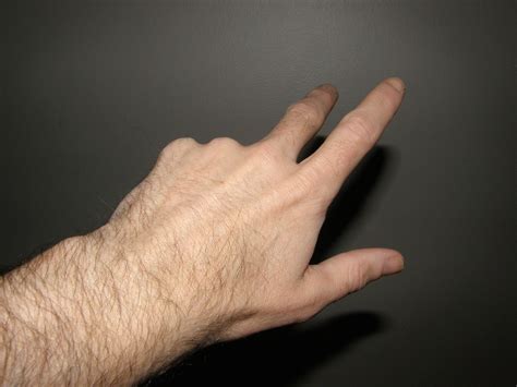 Wrist Sprain Swelling