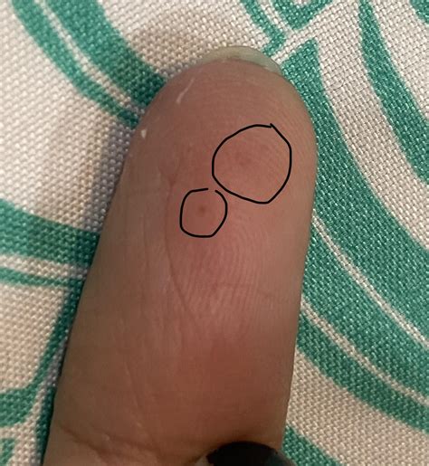 Small ‘holes’ under my skin. Any suggestions? Apologies for low quality