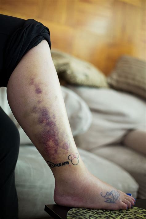 Rattlesnake bite victim recovering | Local | yakimaherald.com