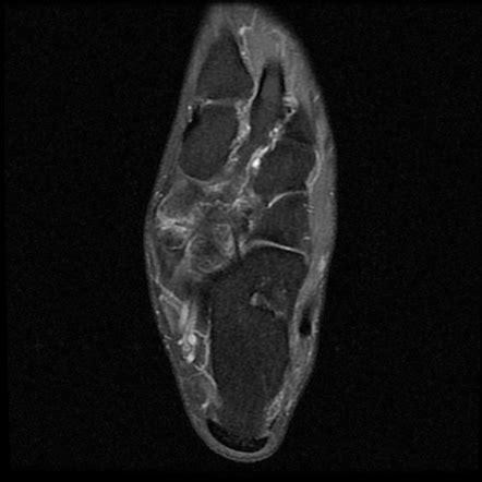 Accessory navicular | Radiology Reference Article | Radiopaedia.org