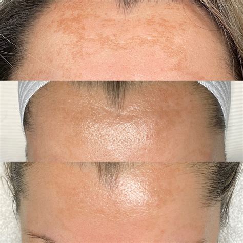 Melasma & Pigmentation — Meraki Skin Clinic