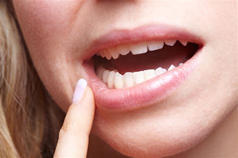 Bell's Palsy | MedlinePlus