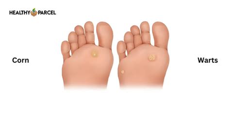 What Is The Difference Between A Corn And A Wart On The Foot