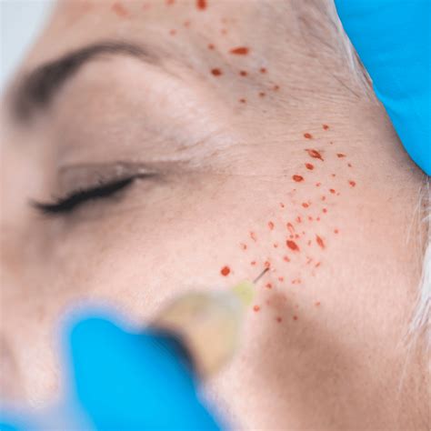 NeoGen Plasma Skincare Treatment | Affiliated Dermatology