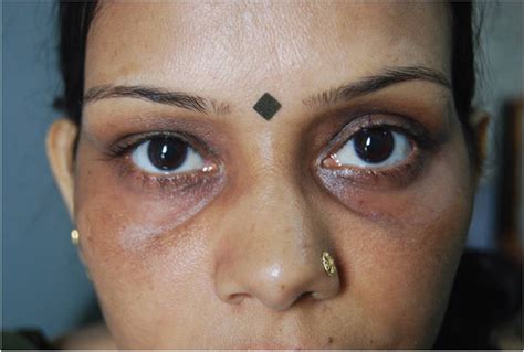 hyperpigmentation | Messina Esthetic Medicine