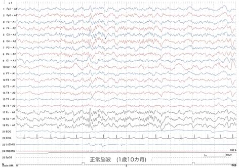てんかんネット | 点頭てんかん