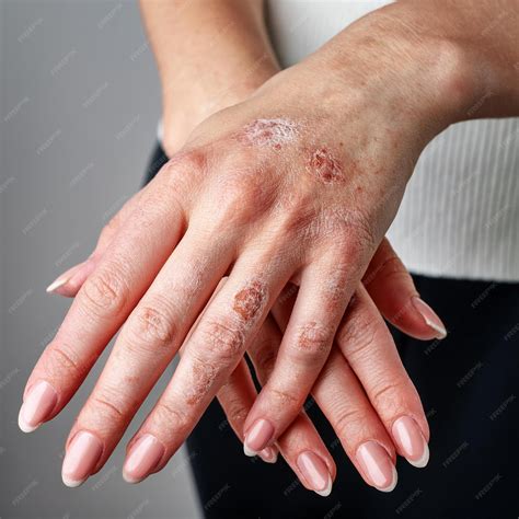 Psoriasis on hands of patient young girl hand closeup | Premium AI
