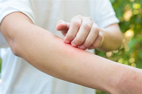 AlergiaDexeus: Expertos en Alergia Barcelona - Hospital Universitari Dexeus