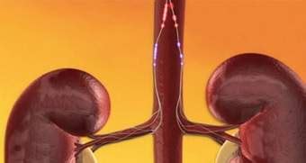 Renal Denervation | Marengo Asia CIMS Hospital - Best Hospital in Ahmedabad