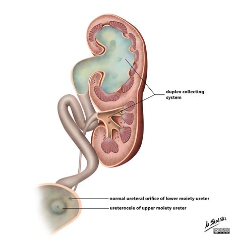 Duplex kidneys | infoKID