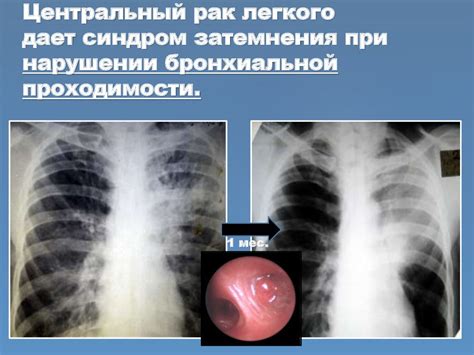 Рентгенологические проявления патологических процессов в легких ...