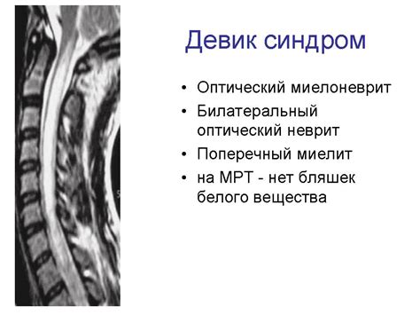 ГМ. Рассеянный склероз 1. + | Портал радиологов