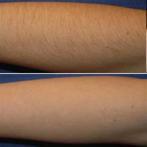 Laser Hair Removal Arms Before After Online | centralcountiesservices.org