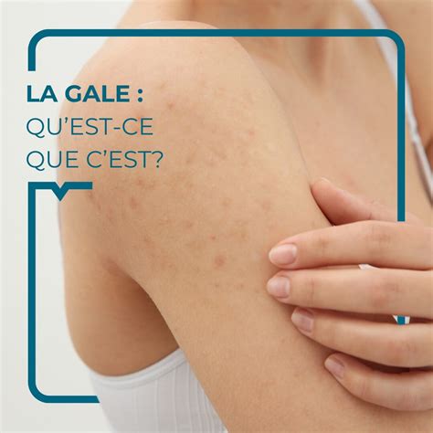 la gale symptomes traitements  prevention alegria medical centre