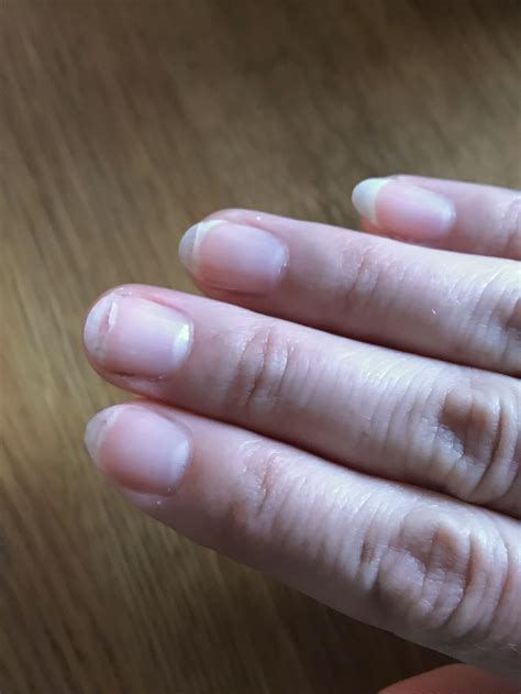 White Nail Disease at Holly Mellott blog