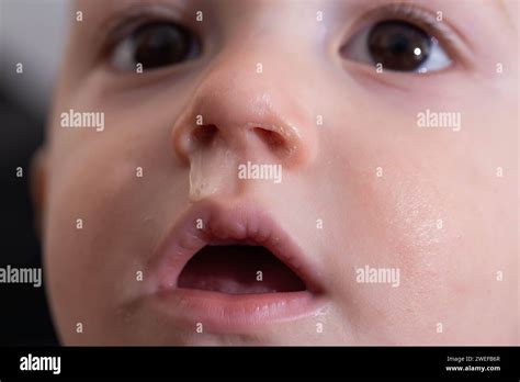 Yellow snot from a child s nose, close-up. Sinus infections, colds and ...